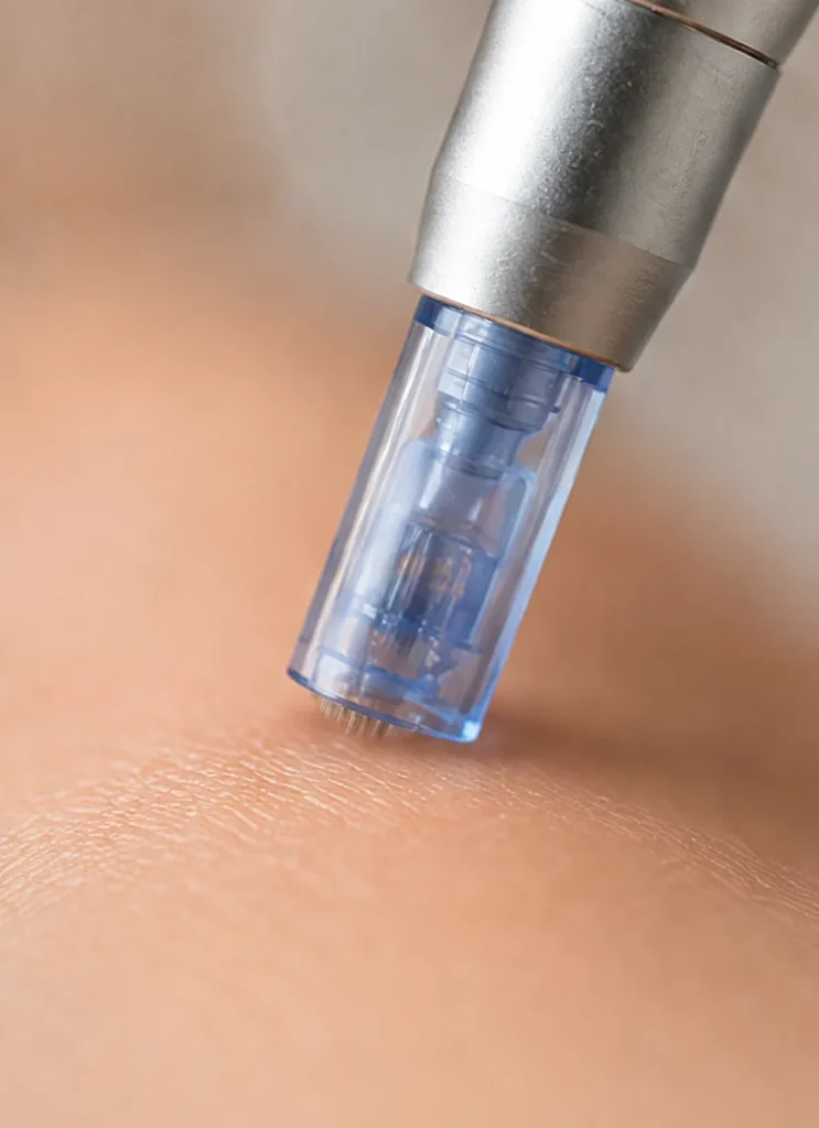 Embout de microneedling à micro-aiguilles au contact de la peau