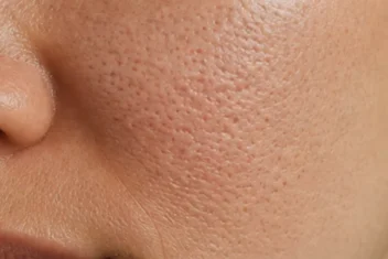 Gros plan d’une peau présentant des pores dilatés visibles sur le visage