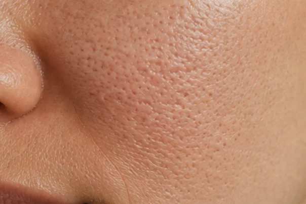 Gros plan d’une peau présentant des pores dilatés visibles sur le visage