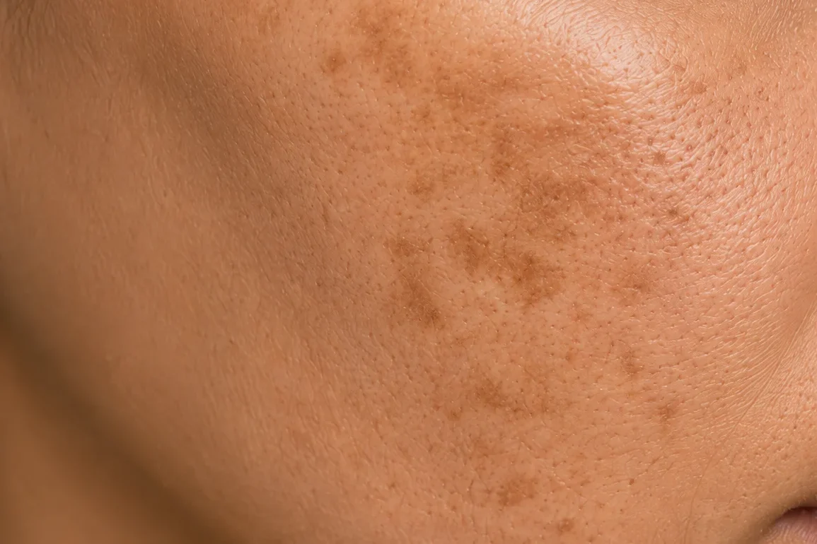 Gros plan de taches pigmentaires sur la joue, une indication du microneedling.