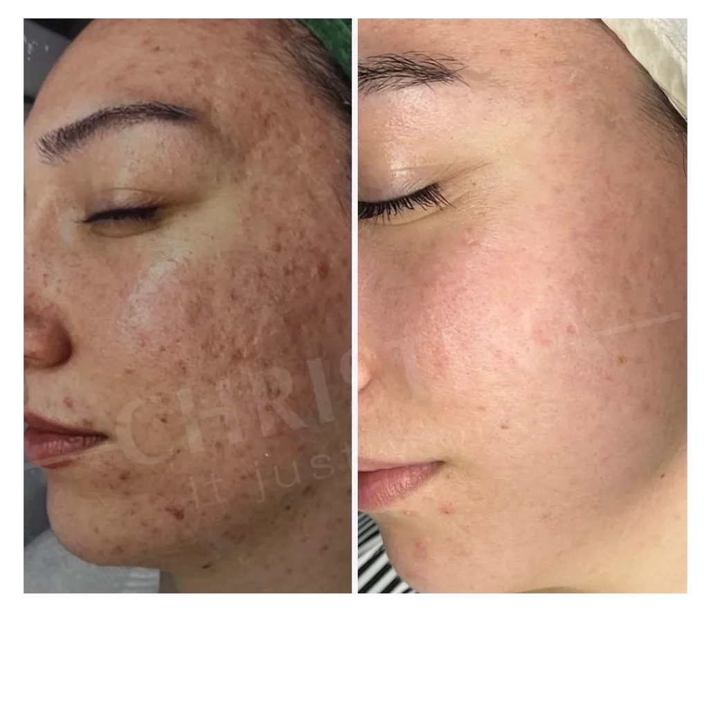 Avant après Peeling Rose de Mer sur les imperfections et la texture de la peau