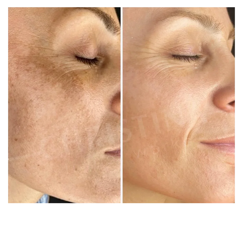 Avant après Peeling Rose de Mer sur l'apparence des taches pigmentaires du visage