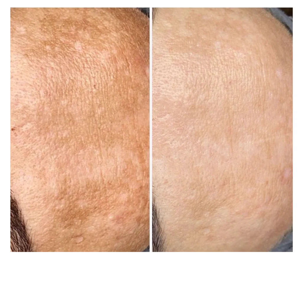 Avant après Peeling Rose de Mer sur l’apparence des taches pigmentaires du front