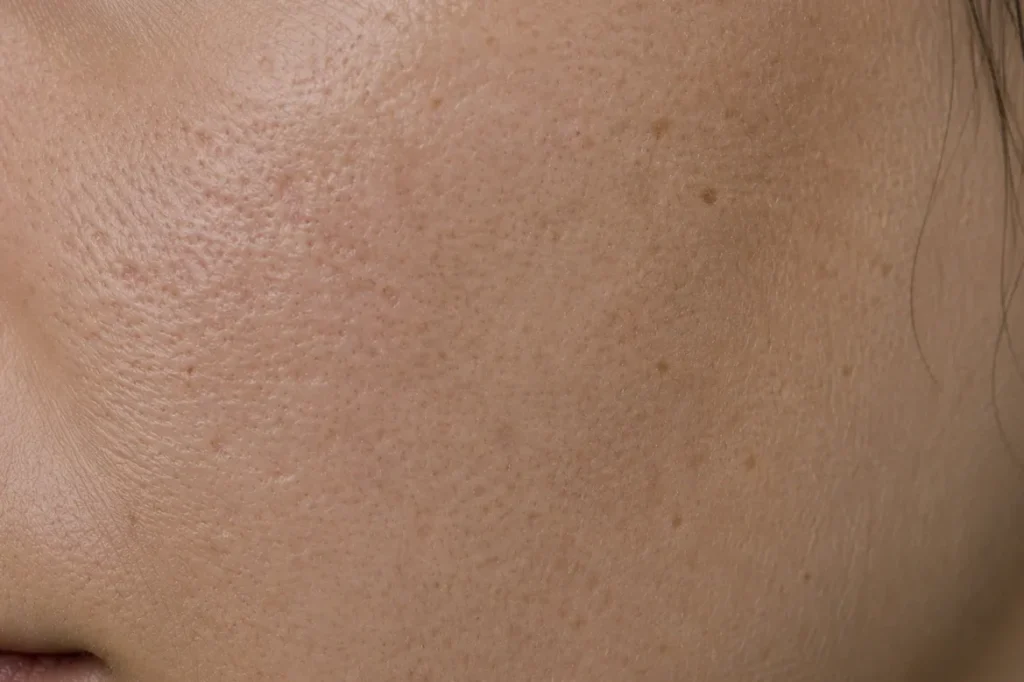 Gros plan d’une joue présentant une texture irrégulière, un grain de peau marqué et des pores visibles