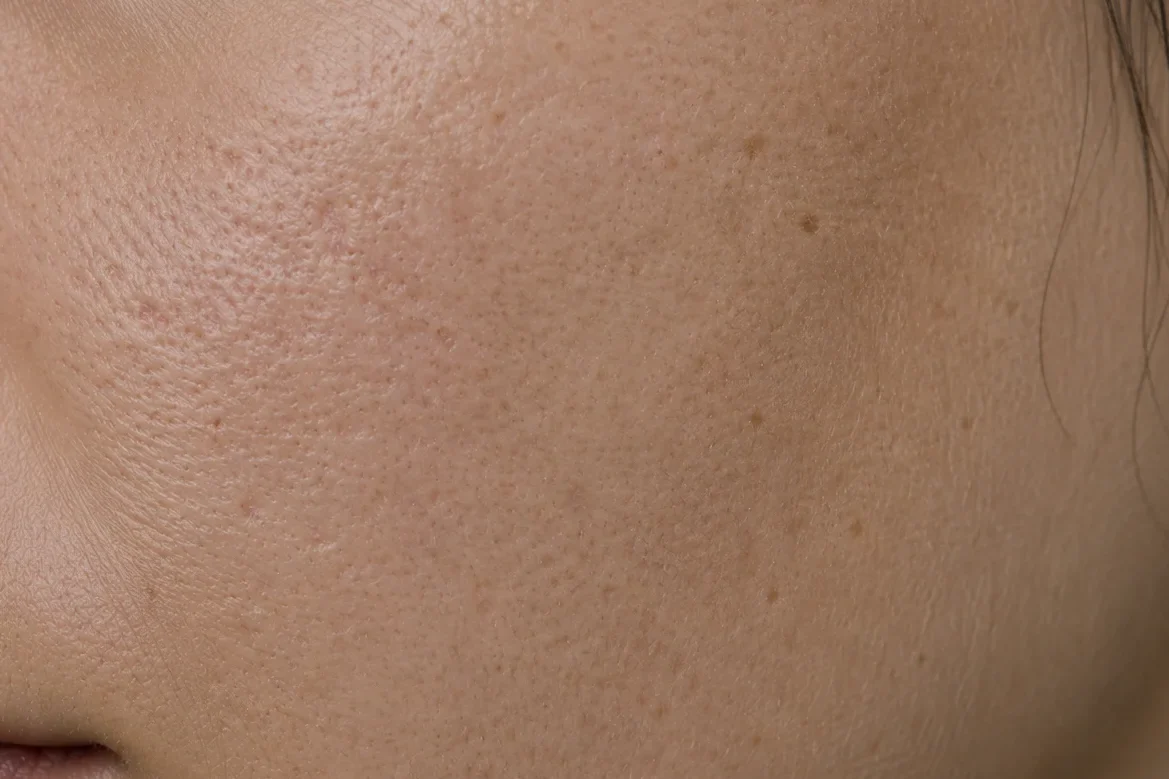 Gros plan d’une joue présentant une texture irrégulière, un grain de peau marqué et des pores visibles