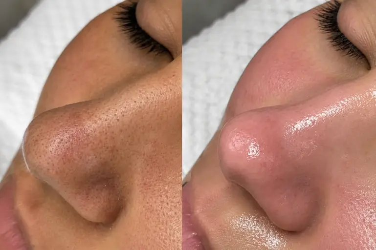 Avant après d’un nettoyage profond du visage montrant des pores désobstrués et une peau plus nette