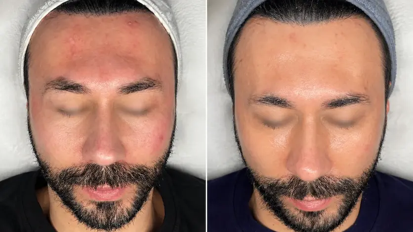 Avant après d’un soin Unstress pour peau stressée et sensibilisée chez SIELLE PARIS