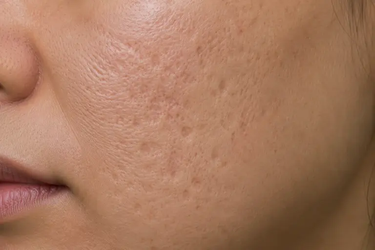 Gros plan d’une joue avec des cicatrices d’acné et une texture de peau irrégulière.