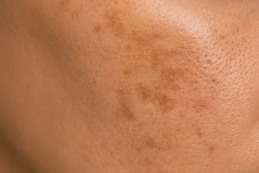 Gros plan de taches pigmentaires sur la joue, une indication du microneedling.