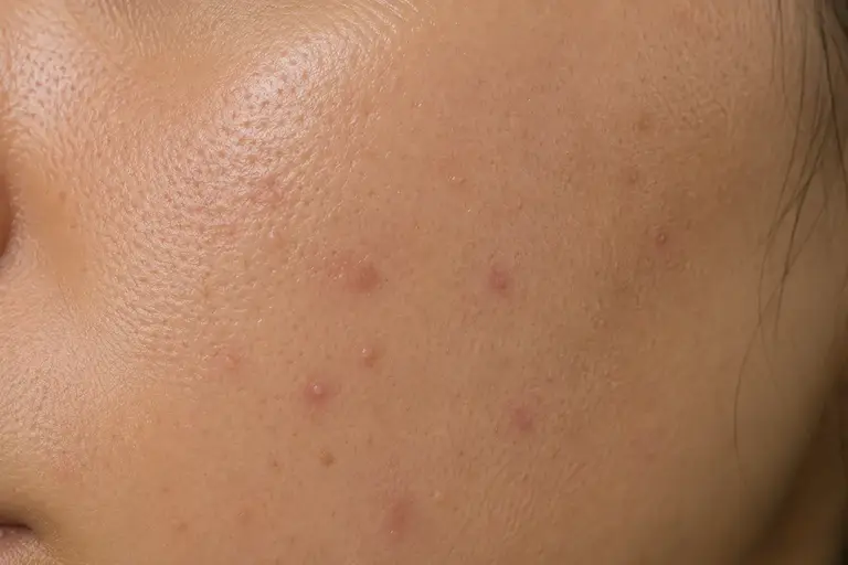 Gros plan d’une peau grasse présentant des imperfections avant un peeling Rose de Mer