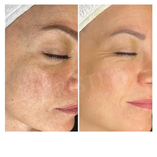 Avant après Peeling Rose de Mer sur l’éclat du teint et l’apparence des pores