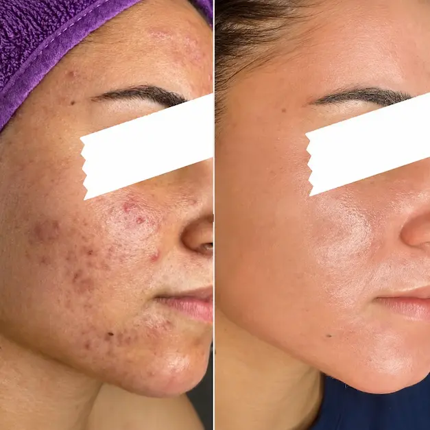 Avant après Peeling Rose de Mer sur une peau présentant des boutons et des imperfections