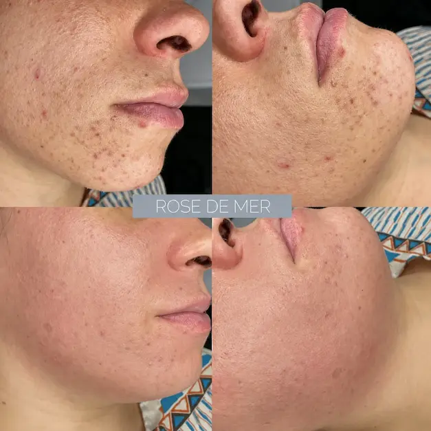 Avant après Peeling Rose de Mer sur les imperfections et la texture de la peau